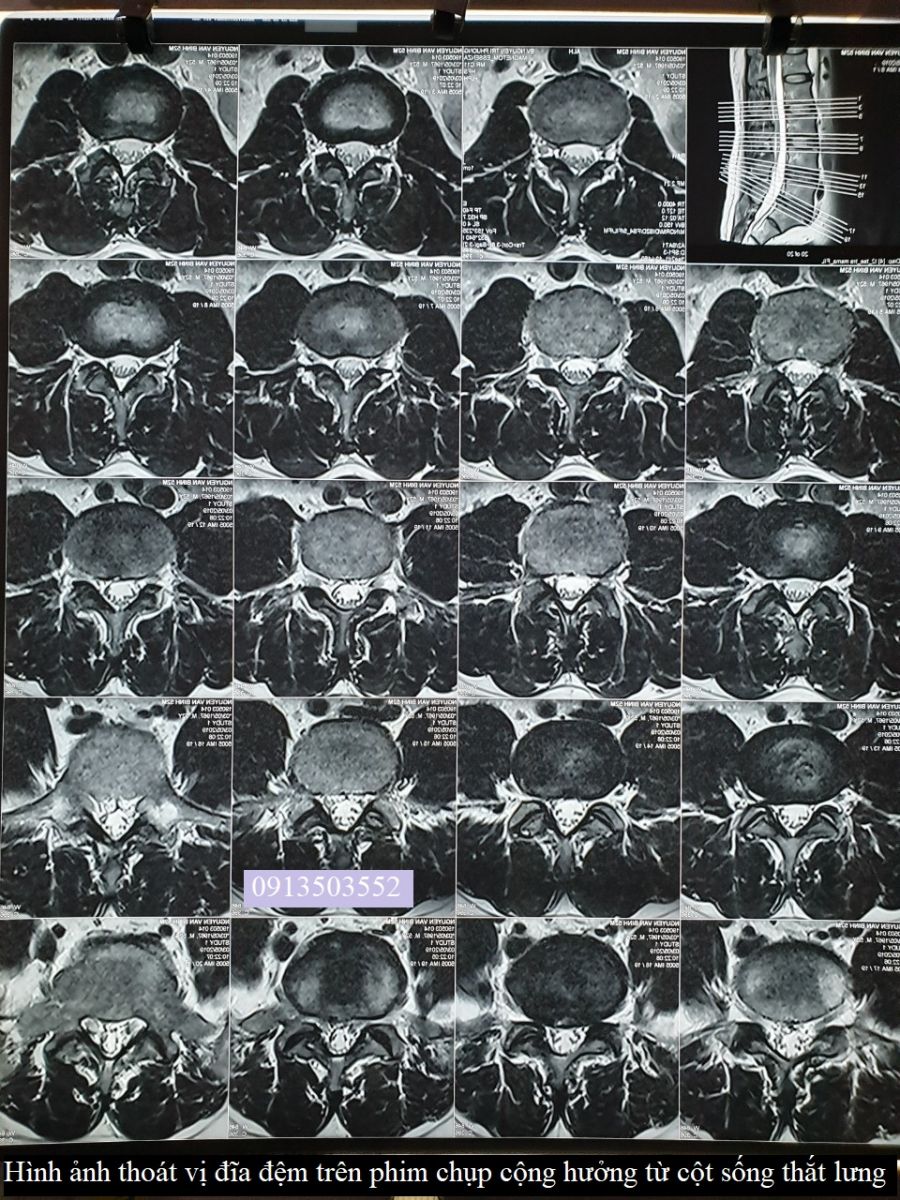 Hình ảnh thoát vị đia đệm 
